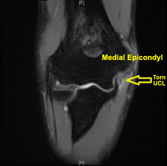 Ulnar Collateral Ligament Reconstruction (Tommy John Surgery)