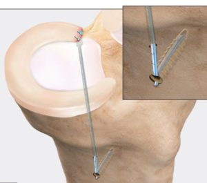 Meniscal Root Repair | Knee Injuries | Dr. Christopher Ahmad