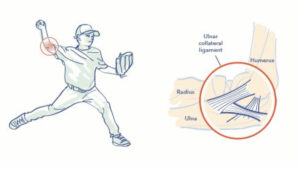 Tommy John Surgery | UCL Injury Overview | Dr. Christopher Ahmad