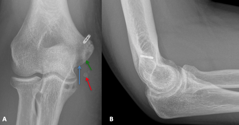 Tommy John Surgery | UCL Injury Overview | Dr. Christopher Ahmad